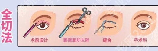 王剑人民医院做双眼皮怎样？术后自然吗？医生是实力派！