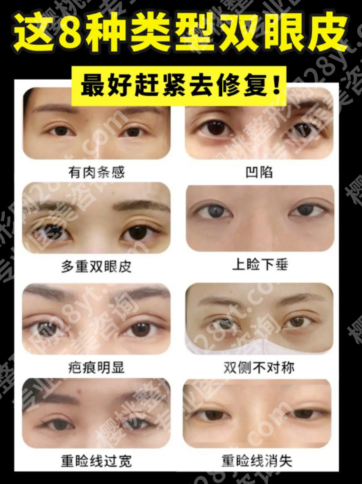 全切双眼皮失败了还能修复吗？别慌！80%的“失败”能修复
