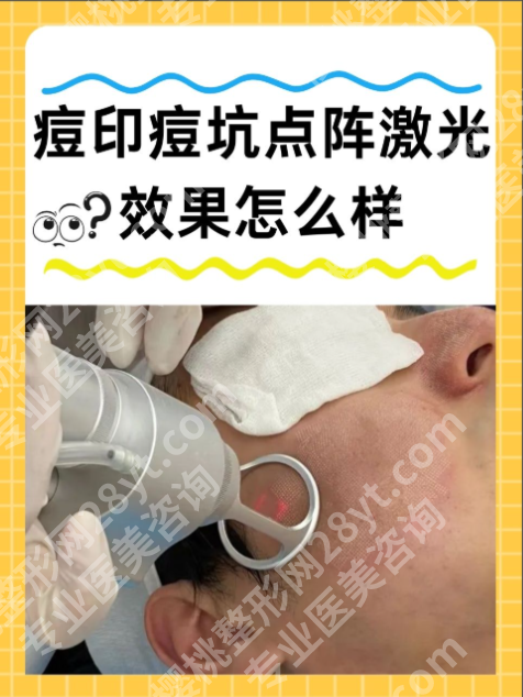广东省皮肤病医院点阵激光怎么样？真人实测祛疤/祛痘/祛斑全攻略