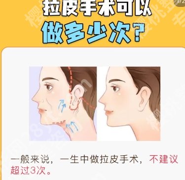 上海第九人民医院拉皮怎么样？一文带你了解详情