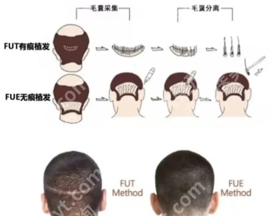 温州医科大学附属第一医院有植发吗？真人植发案例展示！