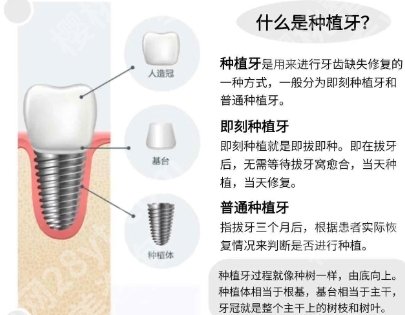 北京安贞医院种植牙价格贵不贵？真实价格等你来看