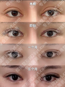 珠海人民医院双眼皮医生案例全解析，看完放心变美！