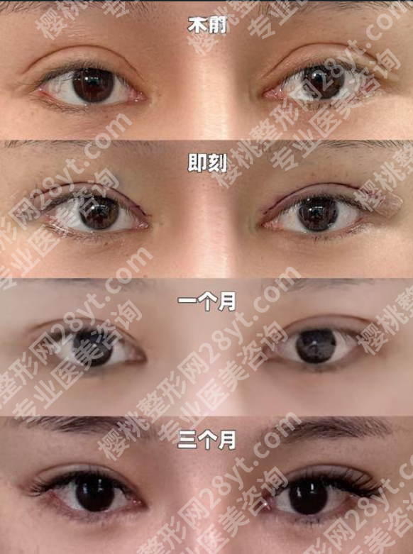 珠海人民医院双眼皮医生案例全解析,看完放心变美!
