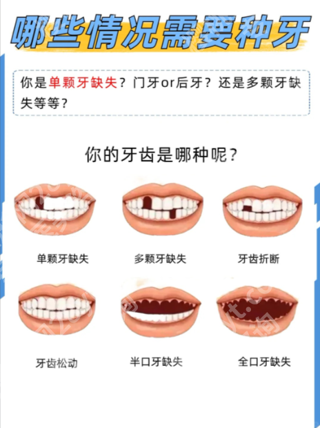 重庆医科大学附属第一医院种植牙怎么样？实力大揭秘，种牙不踩坑！