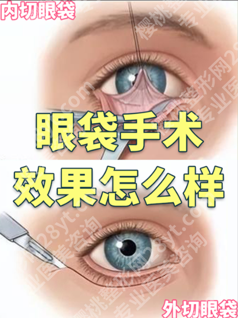 苏州附二院去眼袋手术全攻略：从技术到案例，告别“肿泡眼”