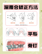 矫正深覆合要拔牙吗？3类案例+2张表，帮你搞懂“拔与不拔”的关键