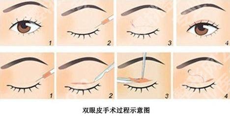 上饶丰艺整形医院正规吗？何为\李荣华院内主推，双眼皮3.8k元起