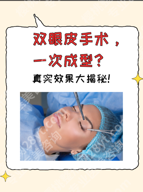 广东省第二人民医院双眼皮手术全攻略：三甲技术+真实案例，自然款双眼皮这样做