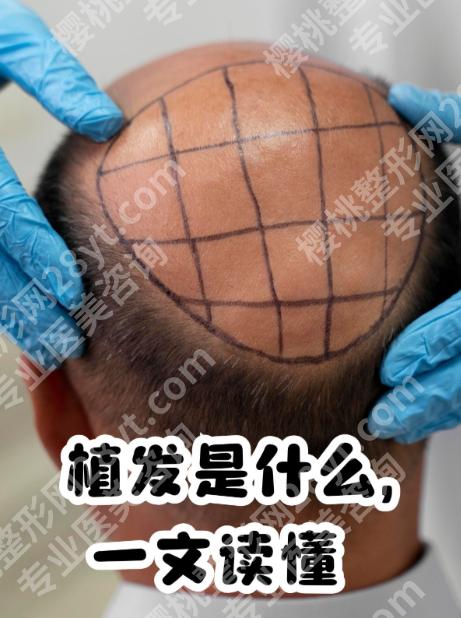 北京大学深圳医院植发中心电话，附超全植发攻略