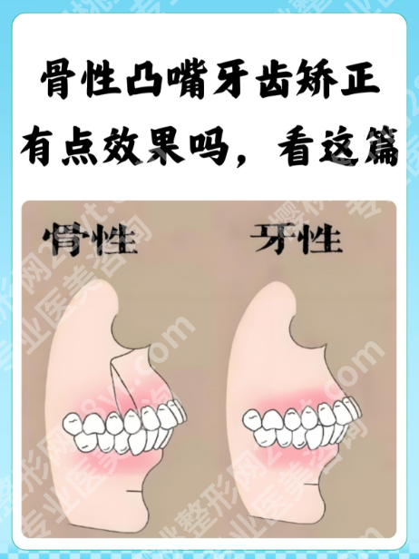 矫正骨性嘴凸要打骨钉吗？正畸医生不会明说的3种情况，看完不纠结！