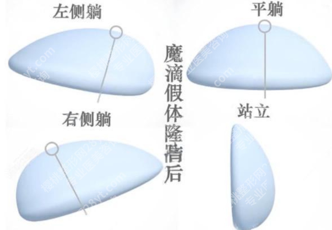 魔滴二代假体一览表：型号/价格/适合人群全拆解，选对不踩坑！
