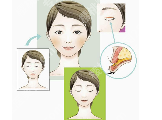 芜湖二院割双眼皮怎样？从技术到案例，3000字干货帮你避坑！