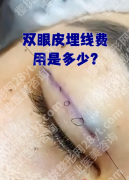 上海华山医院双眼皮埋线费用大揭秘！从3800到8000，差在哪？