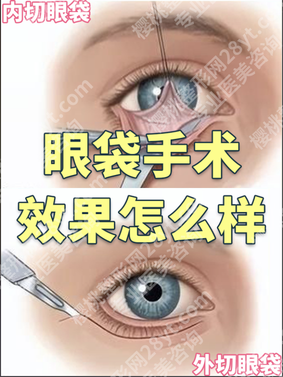 上海东方医院祛眼袋怎么样？0.1mm精准操作+98%满意度实测