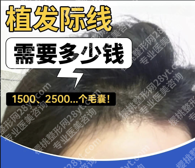 南方医院植发多少钱？技术定价表，15元/单位的背后揭密