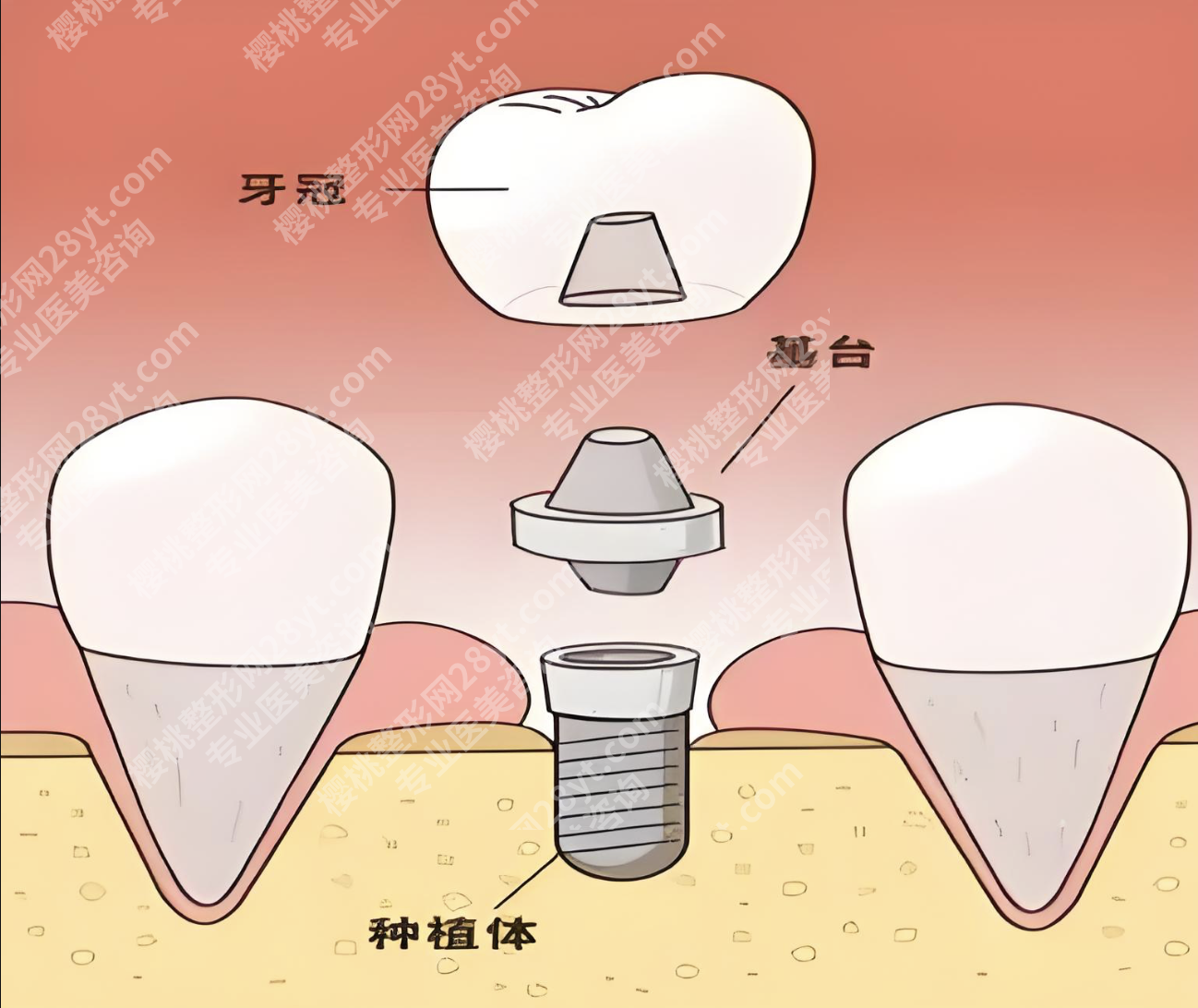 世纪坛医院种植牙怎么样？本地人的这些福利和技巧，医生不会主动说
