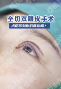 做全切双眼皮多久可以同房？要“等”这3个阶段，不是矫情，是为了恢复
