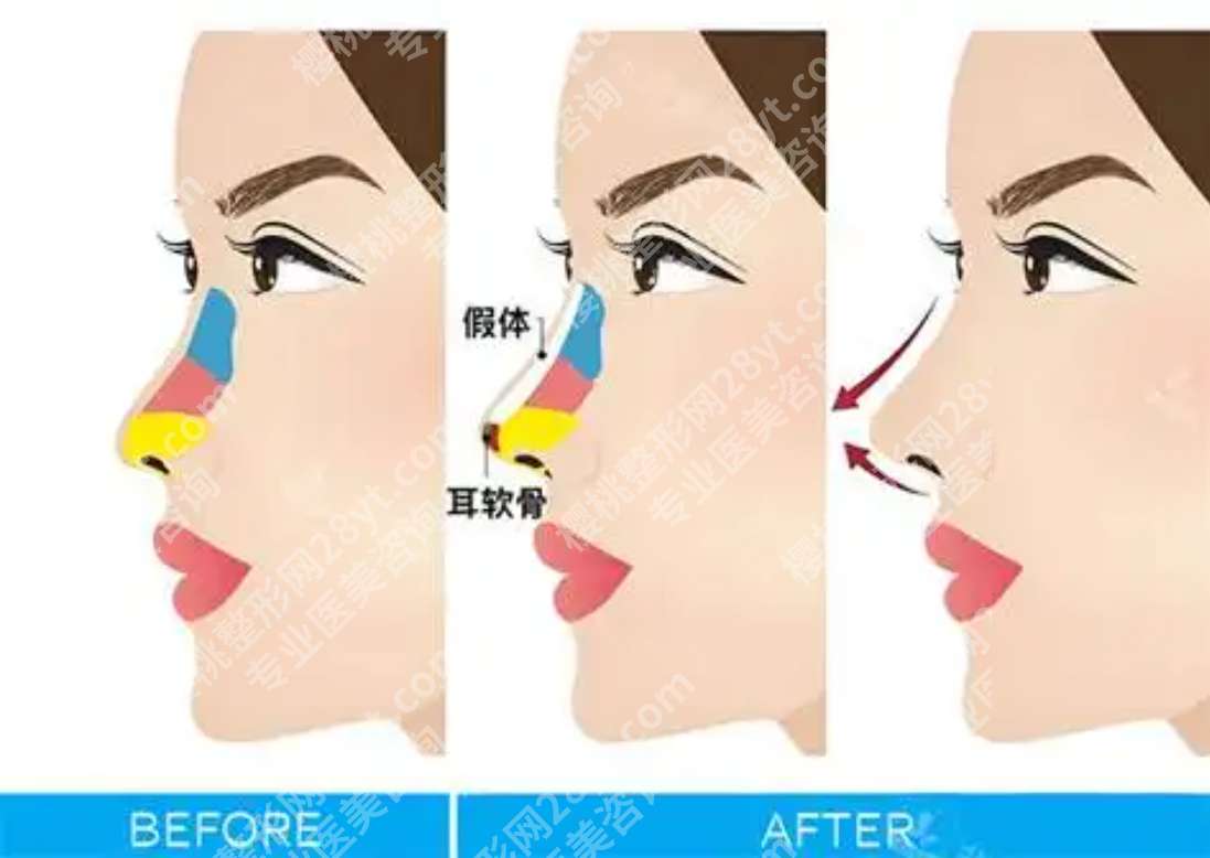 北医三院隆鼻比较好的医生：这些医生闭眼冲！