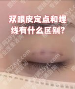 定点双眼皮和埋线哪个恢复快？核心对比，一篇讲清不踩坑