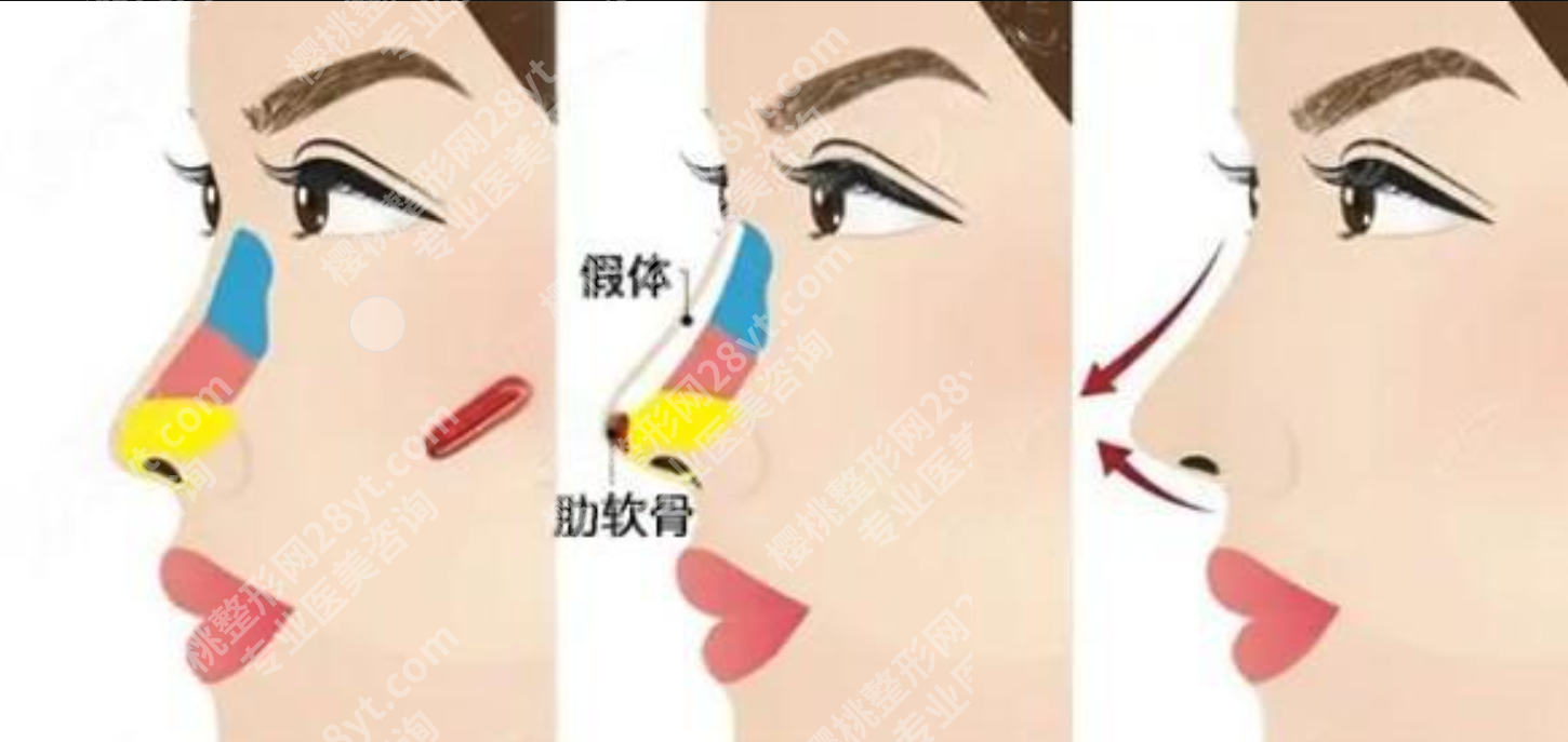 肋软骨隆鼻价格大揭秘！2张表格+3个真实账单，这钱到底花在哪？