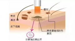 重庆西南医院祛斑多少钱？选对方案比纠结价格更重要！