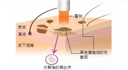 重庆西南医院祛斑多少钱？选对方案比纠结价格更重要！