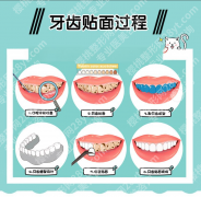 牙贴面是怎么贴上去的？一篇看懂牙齿美容的全过程