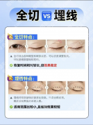 定点双眼皮和埋线的区别：3分钟搞懂怎么选，附真实案例与避坑指南