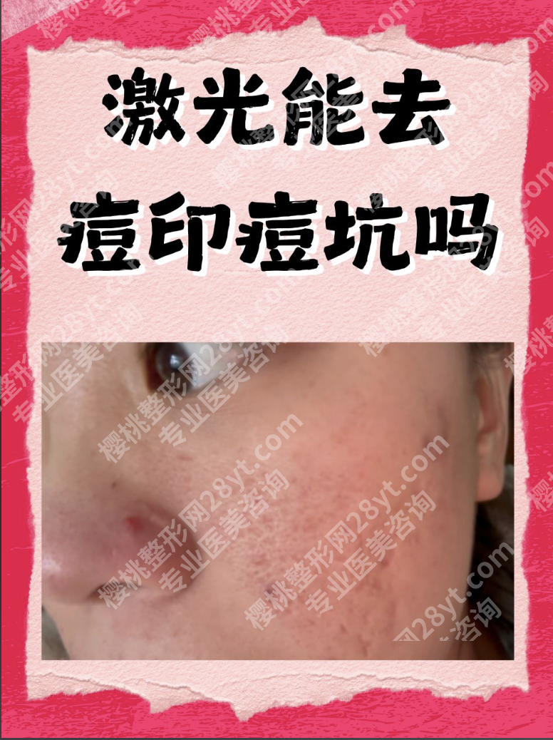 激光祛痘印能彻底去掉吗？3个关键影响因素，很多人忽略了