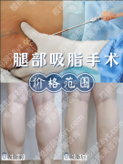 2025合肥大腿吸脂费用价格参考+医院排名，学生党/宝妈适配方案全解析
