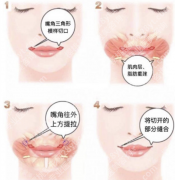 微笑唇整形手术能维持多久？2大类术式维持时间大不同（附核心参数表）
