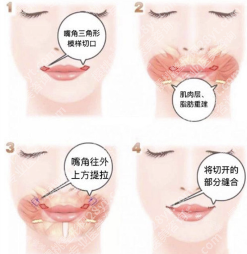 微笑唇整形手术能维持多久？2大类术式维持时间大不同（附核心参数表）