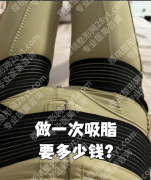 深圳瘦大腿吸脂多少钱？哪家好？