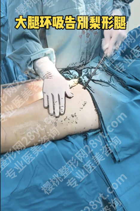 郑州大腿抽脂好的医院排行榜：看这4家，技术、案例、口碑全解析