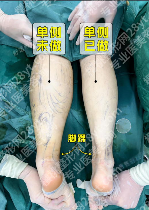 北京大腿吸脂哪里做得好？选对医院腿围直降8cm