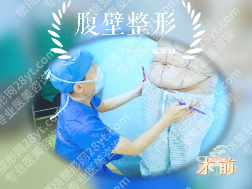 苏州腹壁整形术好的医院排名：选对医院，肚子小3圈不反弹