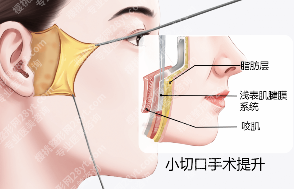 南京医院可以做小拉皮手术吗？3家靠谱机构+2张表，下颌线/法令纹修复全实测