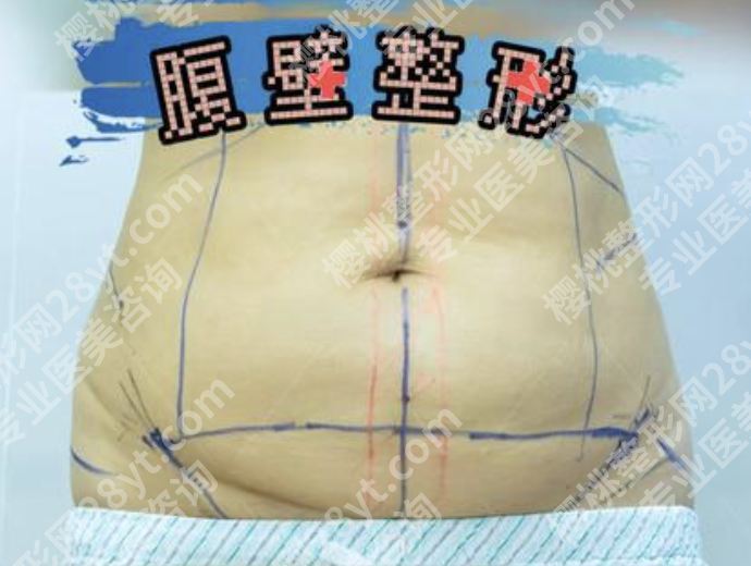 重庆腹壁整形术好的医生：3 位顶流医生+2 张表，产后松/减肥皮耷拉都能救