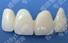 300元1颗的烤瓷牙图片怎么样？这里看看恢复情况如何