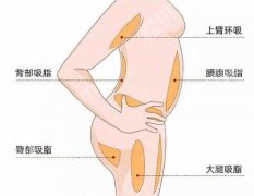 水动力吸脂的切口大小怎么样？怕留疤的姐妹，看完这篇不用慌
