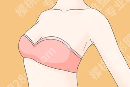 自体脂肪隆胸是终身吗？盘点科普信息，一一在线查看