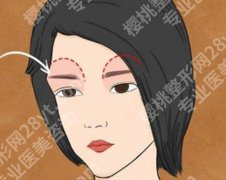 眉弓填充多久恢复正常？不同填充材料，恢复速度差多少?一起了解