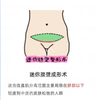 深圳腹壁整形术一般多少钱？医院排名+真实案例