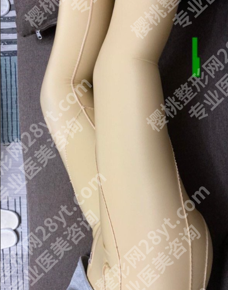 北京大腿吸脂哪家医院好？2025口碑机构盘点，附真实案例避坑指南