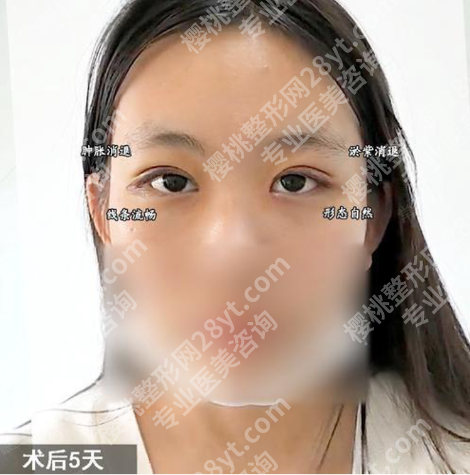 徐靖宏割双眼皮案例揭秘：30年公立名医的“妈生眼”塑造术，附真实恢复全记录