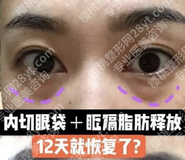 哈尔滨瑞丽做眼袋如何？技术/医生/案例全揭秘，2025避坑指南