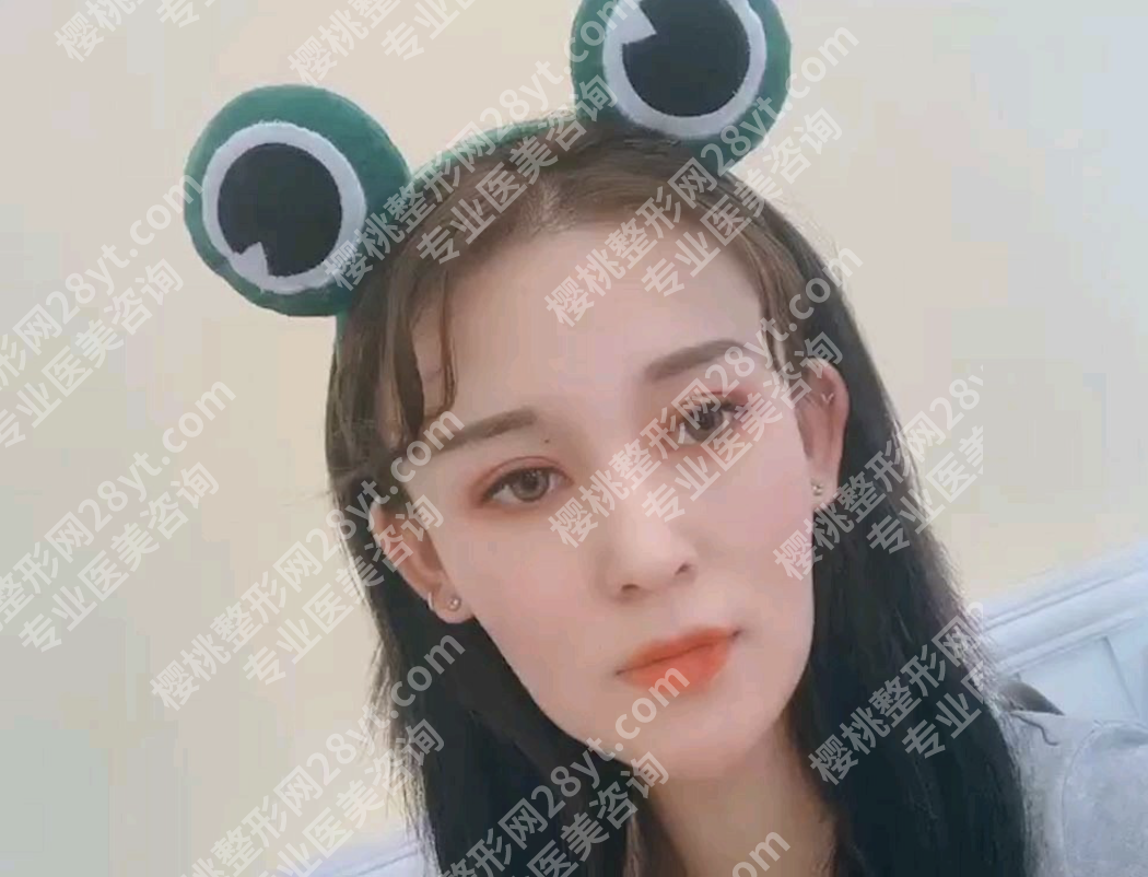 哈尔滨瑞丽做双眼皮怎么样？10年老牌+眼修复王牌，3个真实案例扒透靠谱度
