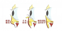 眶隔脂肪释放术多久能恢复？28天时间表+3个真人案例，上班党也能轻松抗衰