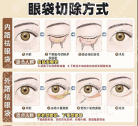 内路祛眼袋和外路祛眼袋的区别：2张表分清差异！3个真实案例教你选对不踩雷